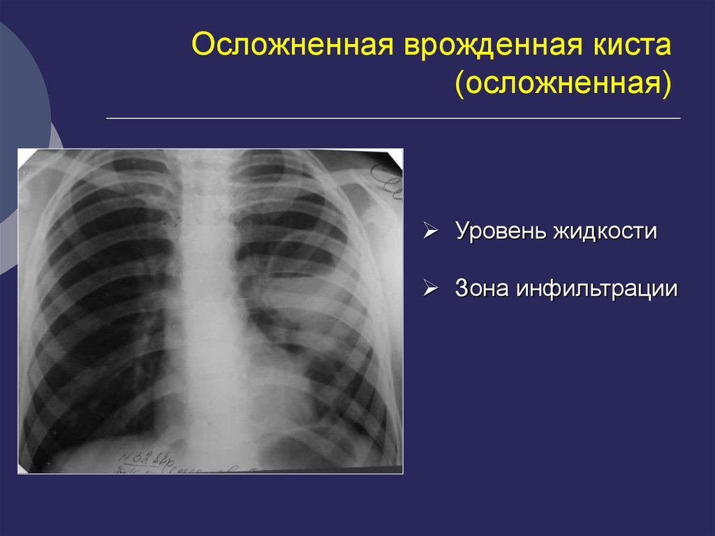 Врожденный туберкулез. Врождённые кисты лёгких. Врожденная киста легкого.