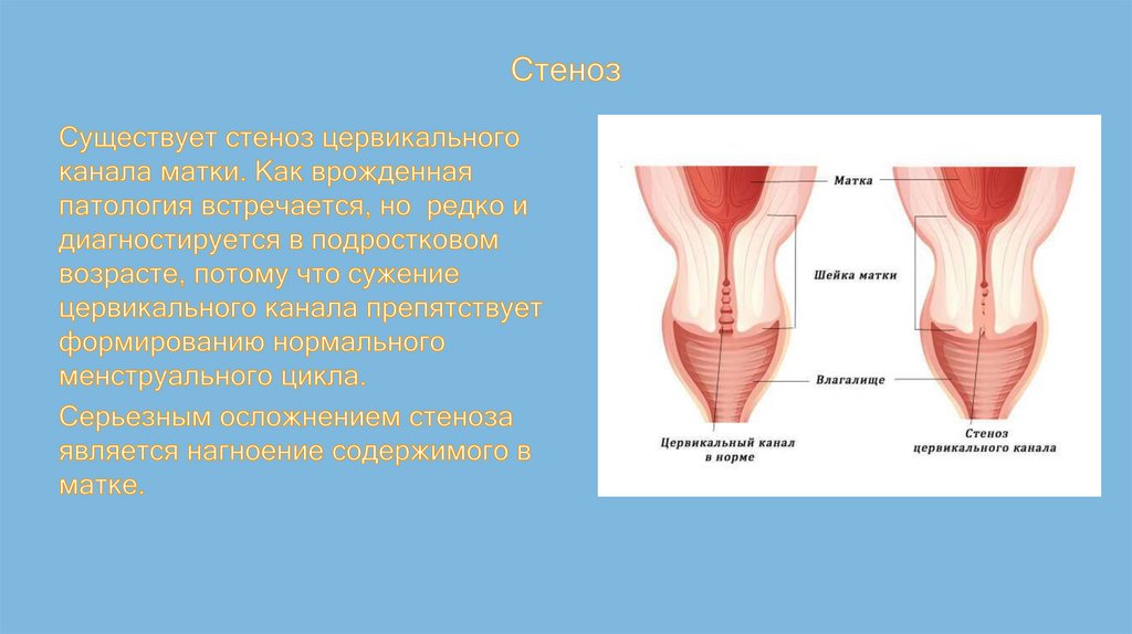 Канал матки. Сужение цервикального канала. Случае стеноза цервикального канала.