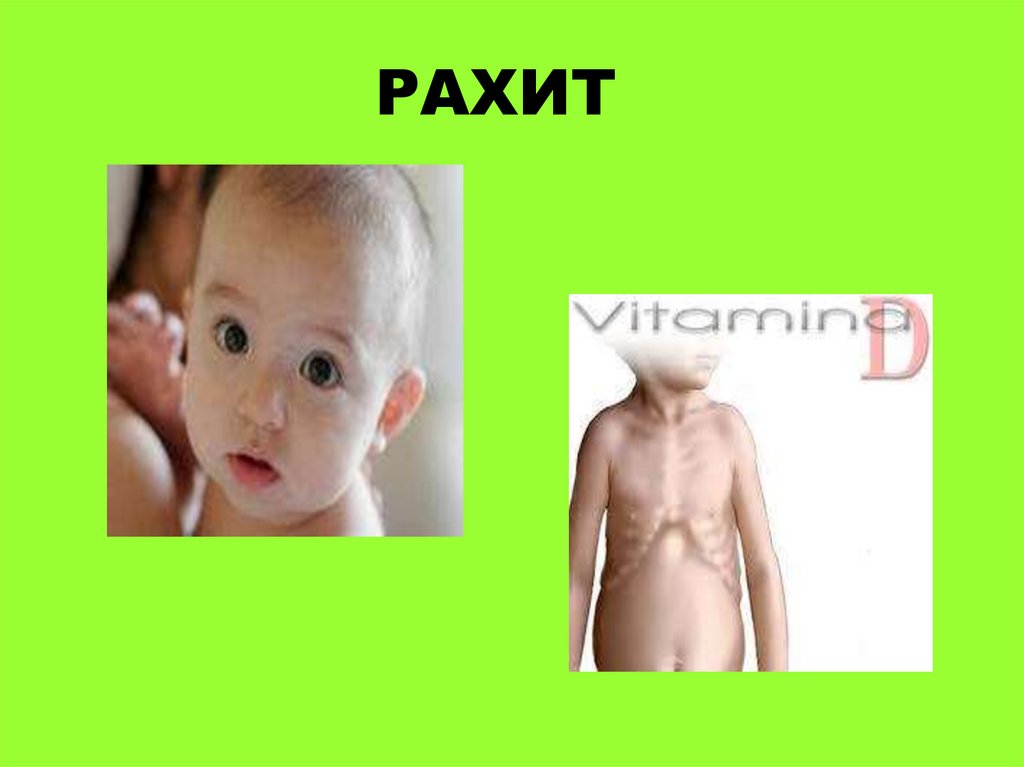 Рахит - презентация онлайн
