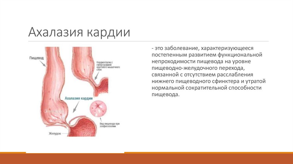 Ахалазия пищевода это. Ахалазия кардии клинические рекомендации. Операция ахалазии пищевода.