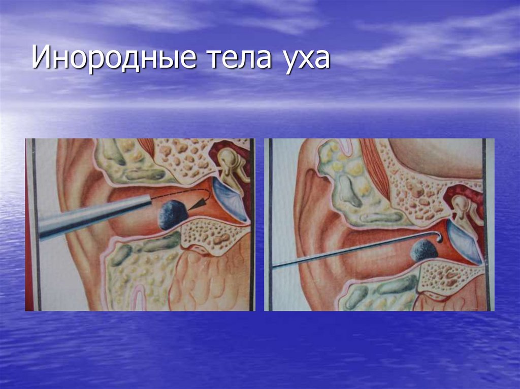 Инородные тела уха
