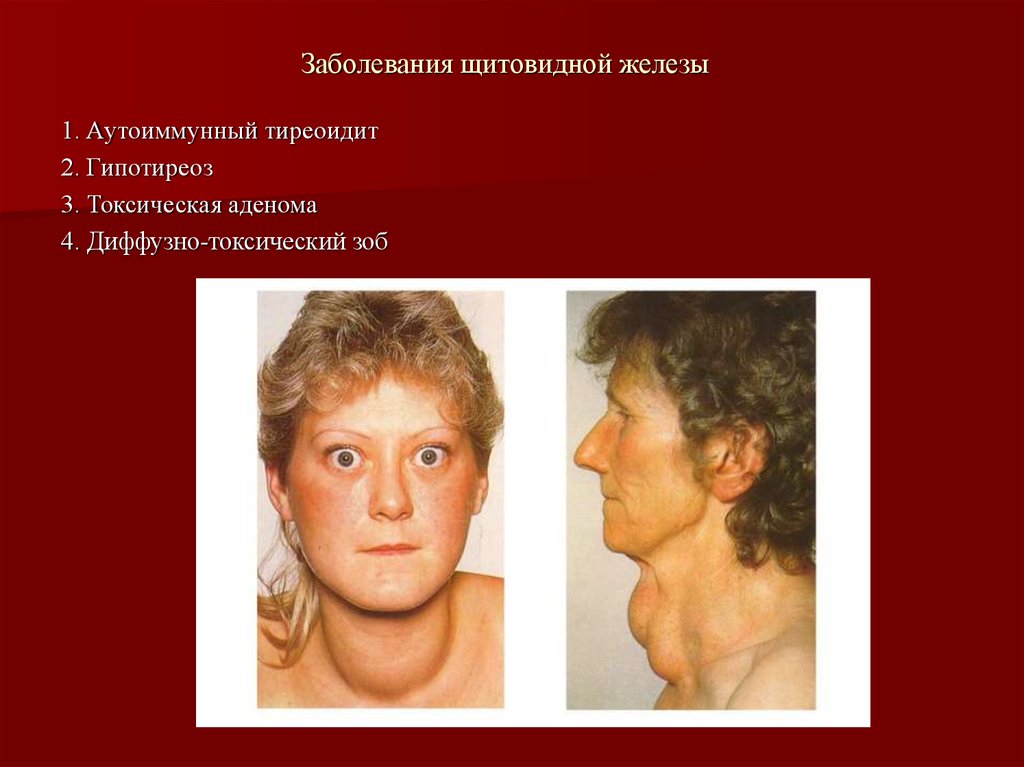 Заболевания щитовидной железы