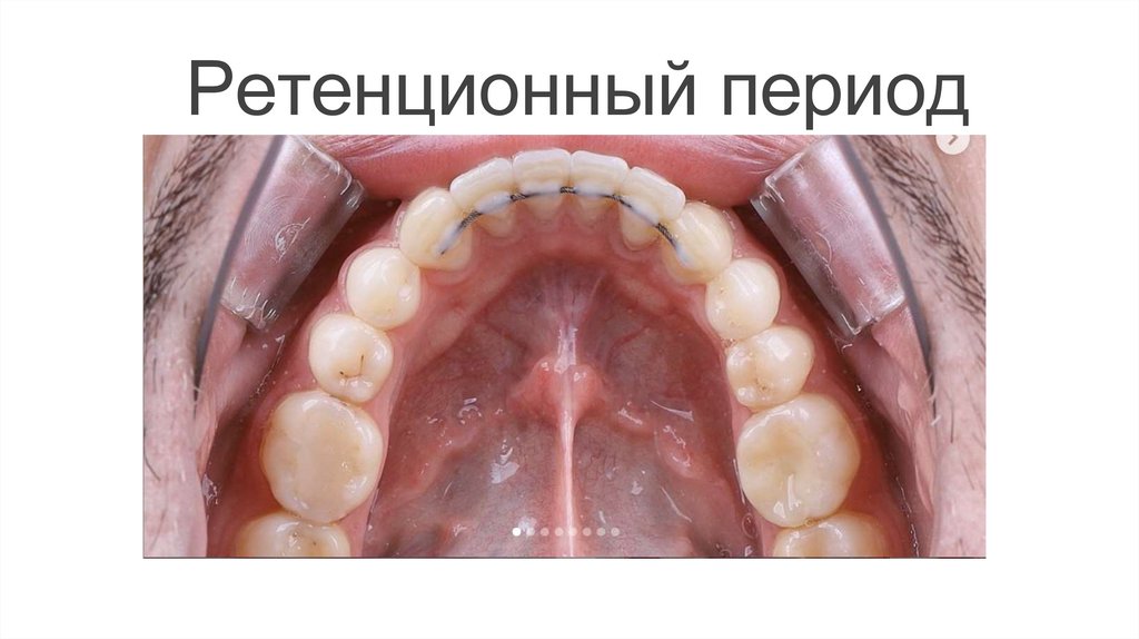 Ретенционный период