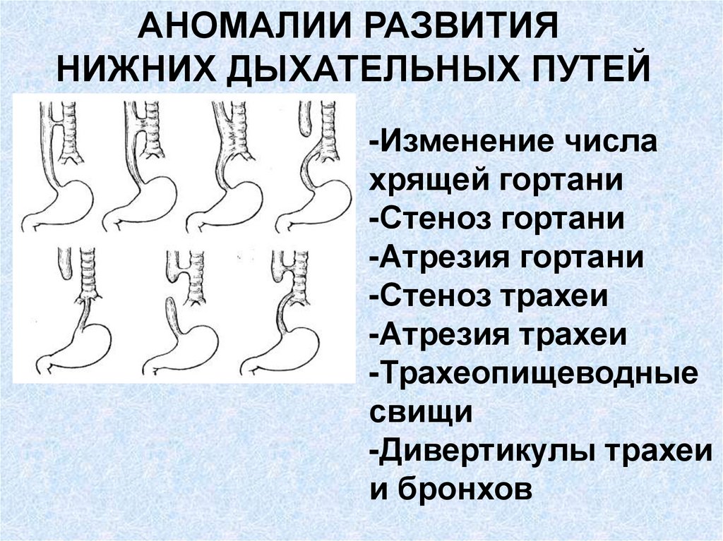 Аномалии развития. Пороки развития органов дыхания. Аномалии развития гортани. Аномалии развития дыхательной системы.