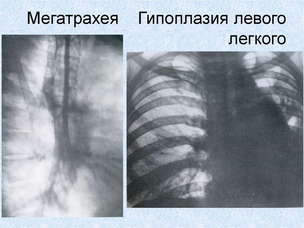 Гипоплазия легкого презентация