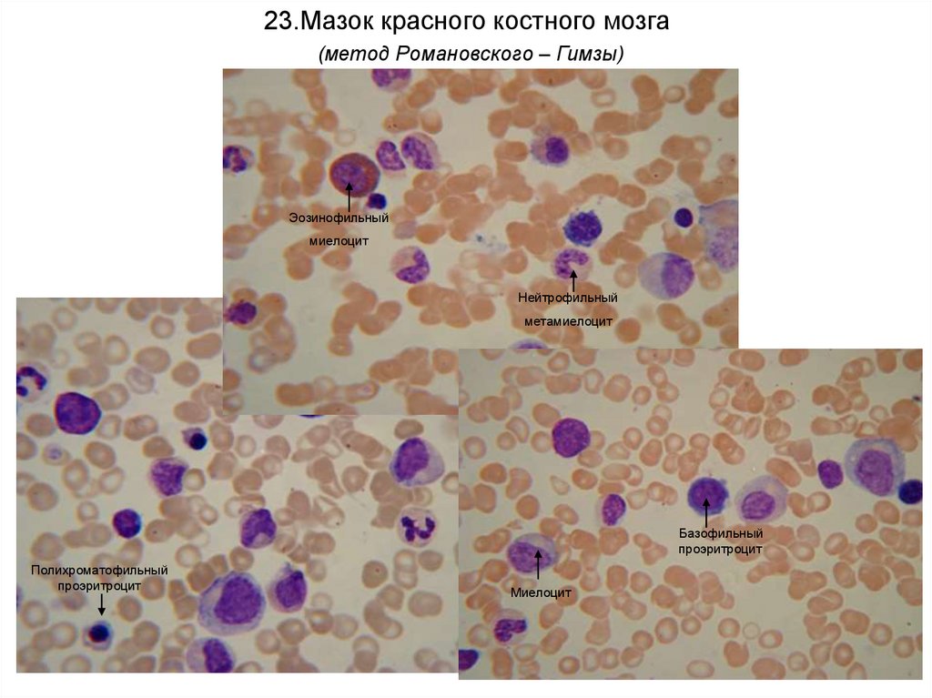 Красный мозг препарат. Красный костный мозг гистология препарат. Мазок красного костного мозга окраска по Романовскому Гимза. Красный костный мозг (окраска: Азур II - эозин). Срез красного костного мозга эозин Азур.