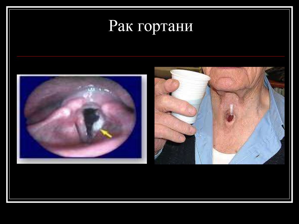 Рак гортани