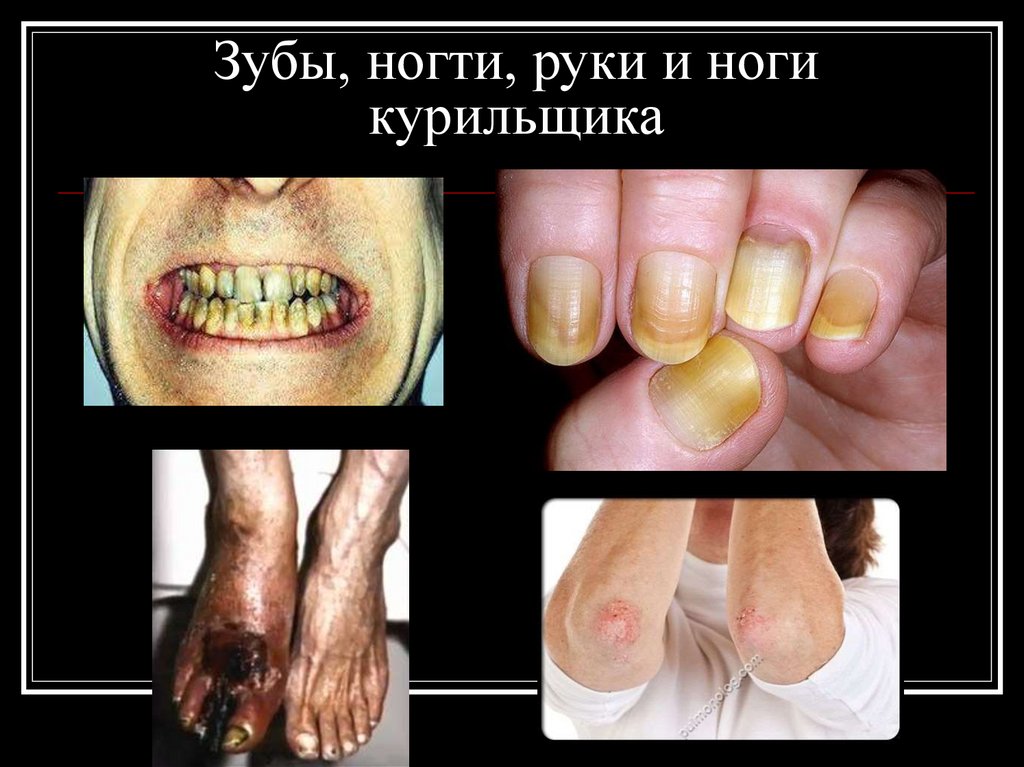 Зубы, ногти, руки и ноги курильщика