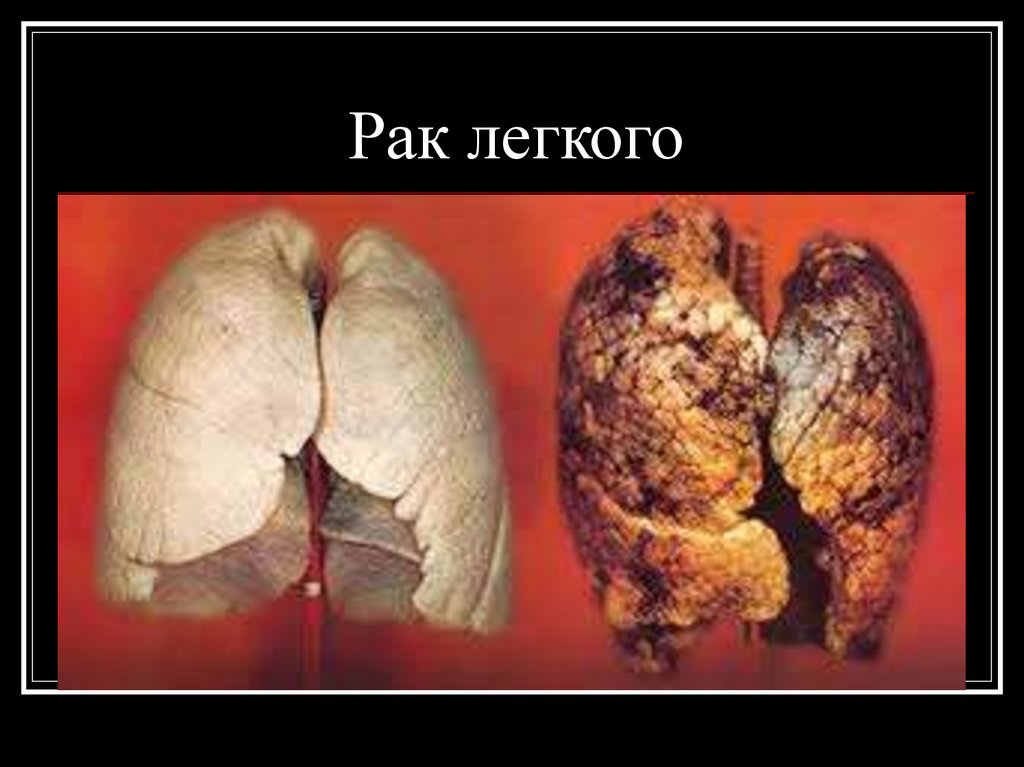 Рак легкого