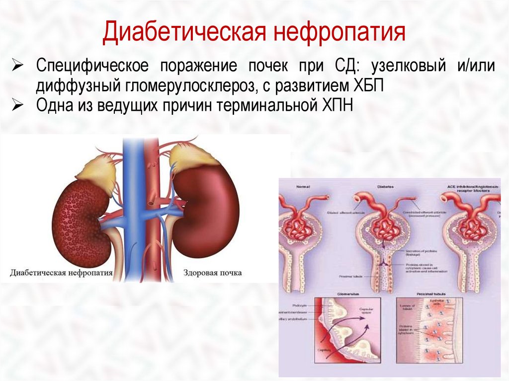 Поражение почек при сахарном диабете