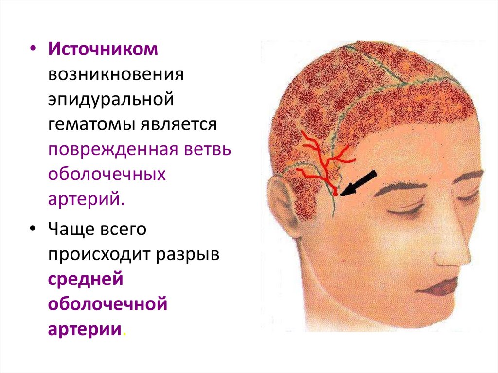 Открытая черепно мозговая травма это