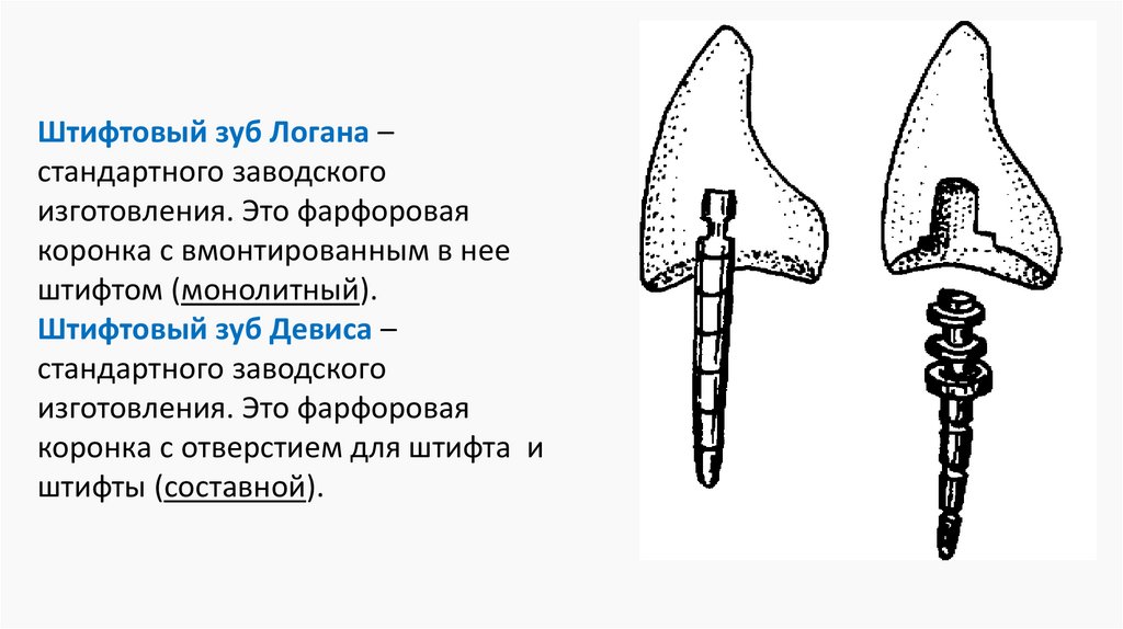 Традиционные и современные штифтовые конструкции