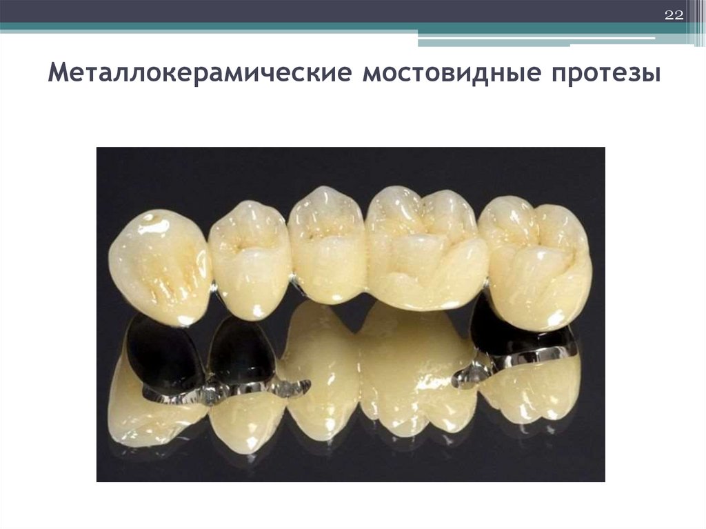 Металлокерамические мостовидные протезы презентация