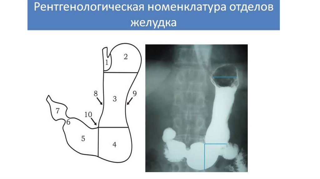 Рентгеноанатомия жкт презентация