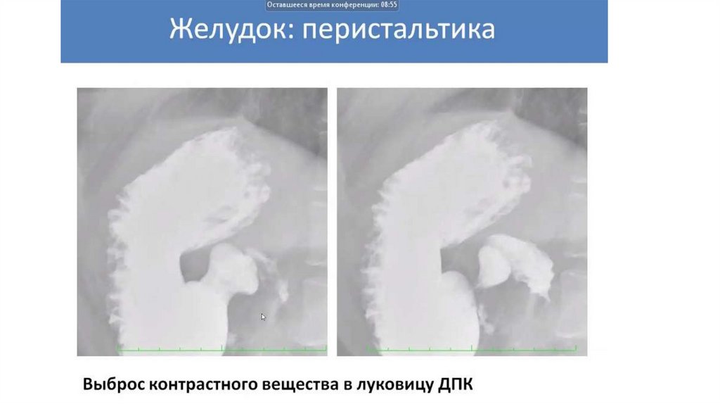 Рентгеноанатомия жкт презентация