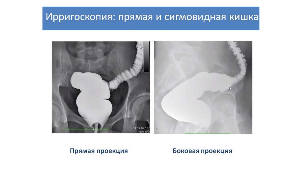 Рентгеноанатомия жкт презентация