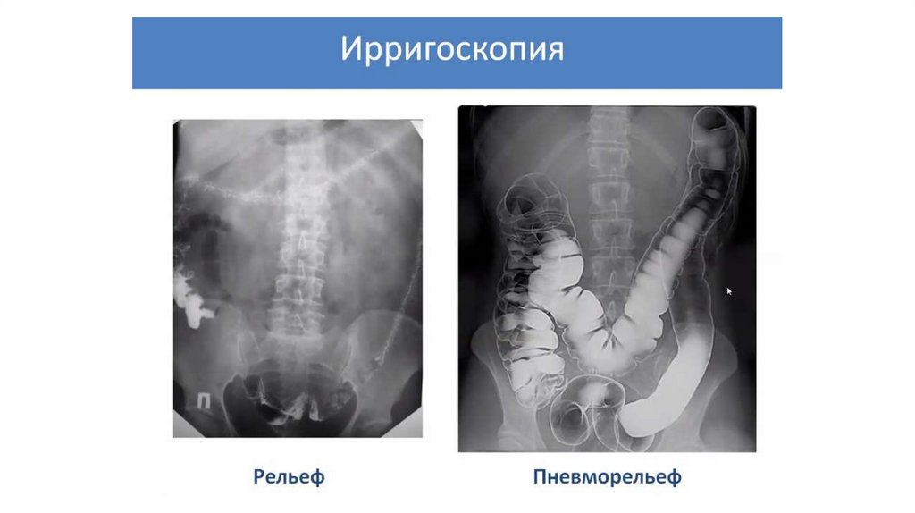 Рентгеноанатомия жкт презентация