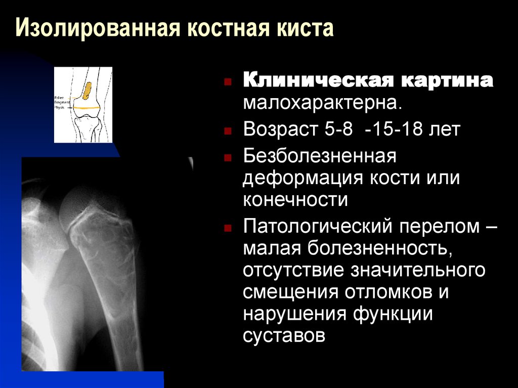 Кт шейки бедра. Костная киста шейки бедренной кости на кт. Простая костная киста бедренной кости. Костная киста головки плечевой кости рентген. Костная киста большеберцовой кости на кт.