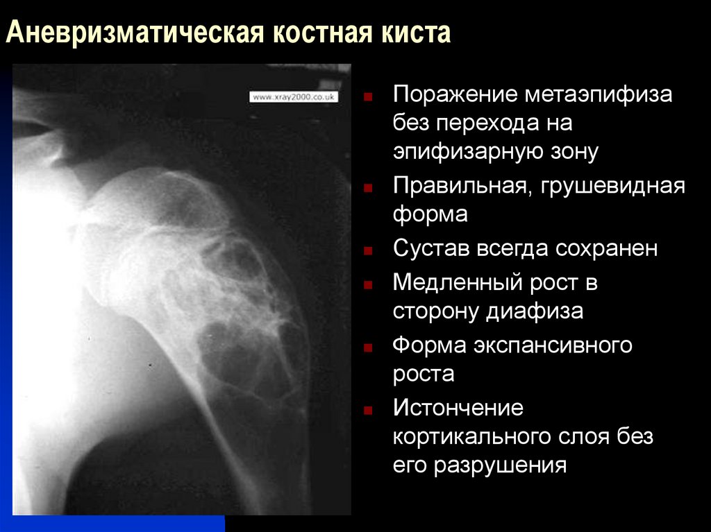 Для рентгенологической картины ячеистой формы гигантоклеточной опухоли характерно