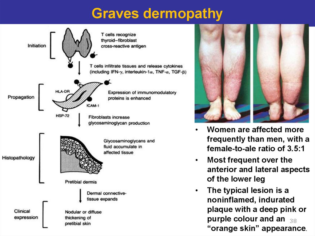 Graves dermopathy