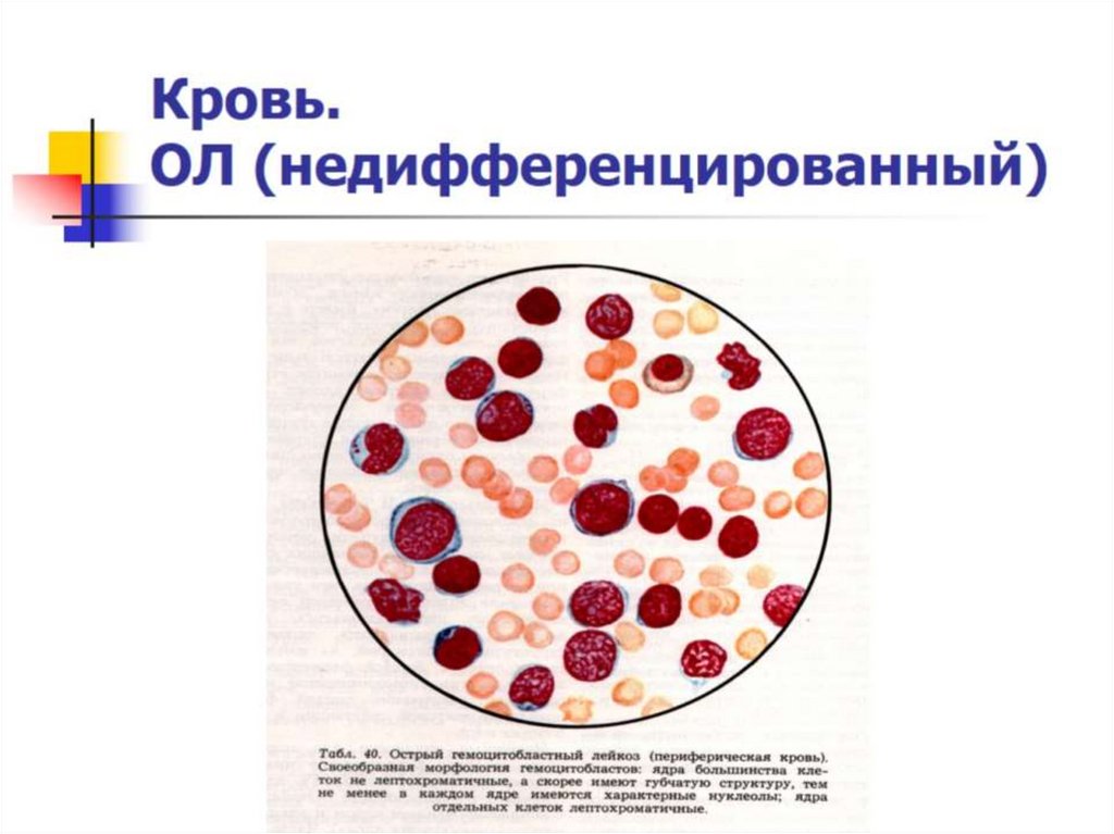Кровь. ОЛ (недифференцированный)