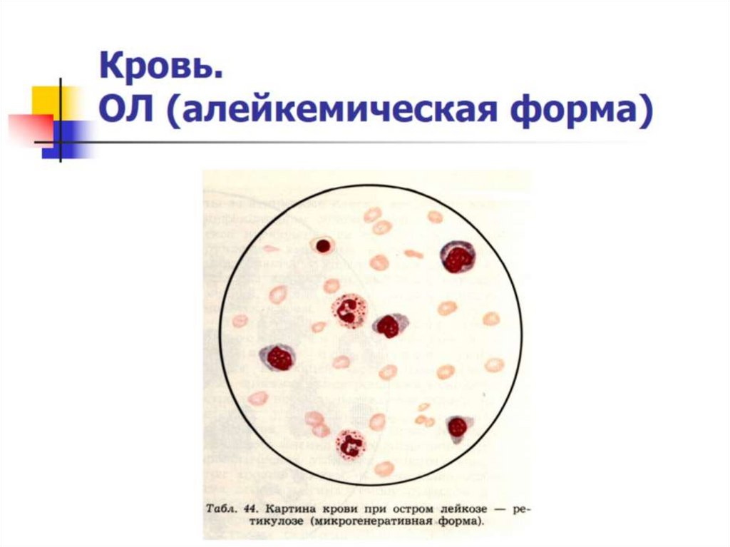 Кровь. ОЛ (алейкемическая форма)