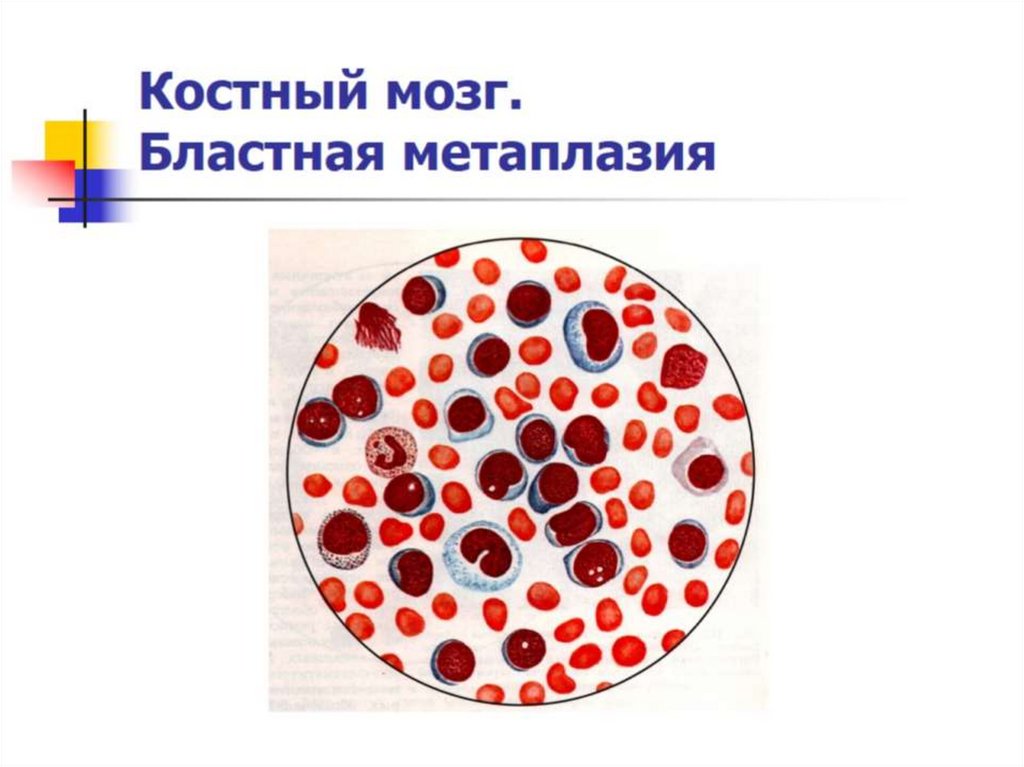 Костный мозг. Бластная метаплазия