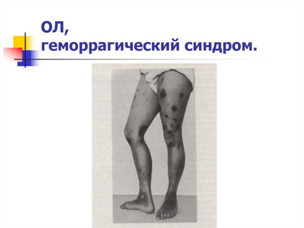 ОЛ, геморрагический синдром.