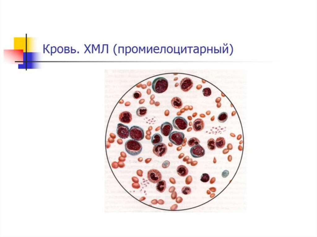 Кровь. ХМЛ (промиелоцитарный)