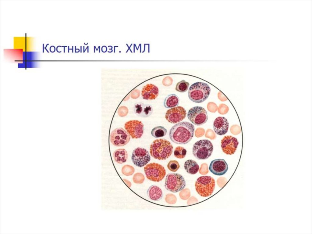 Костный мозг. ХМЛ