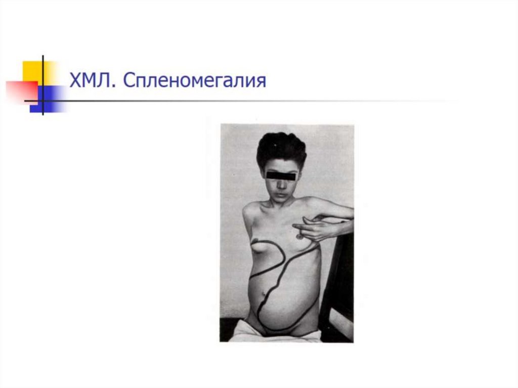 ХМЛ. Спленомегалия