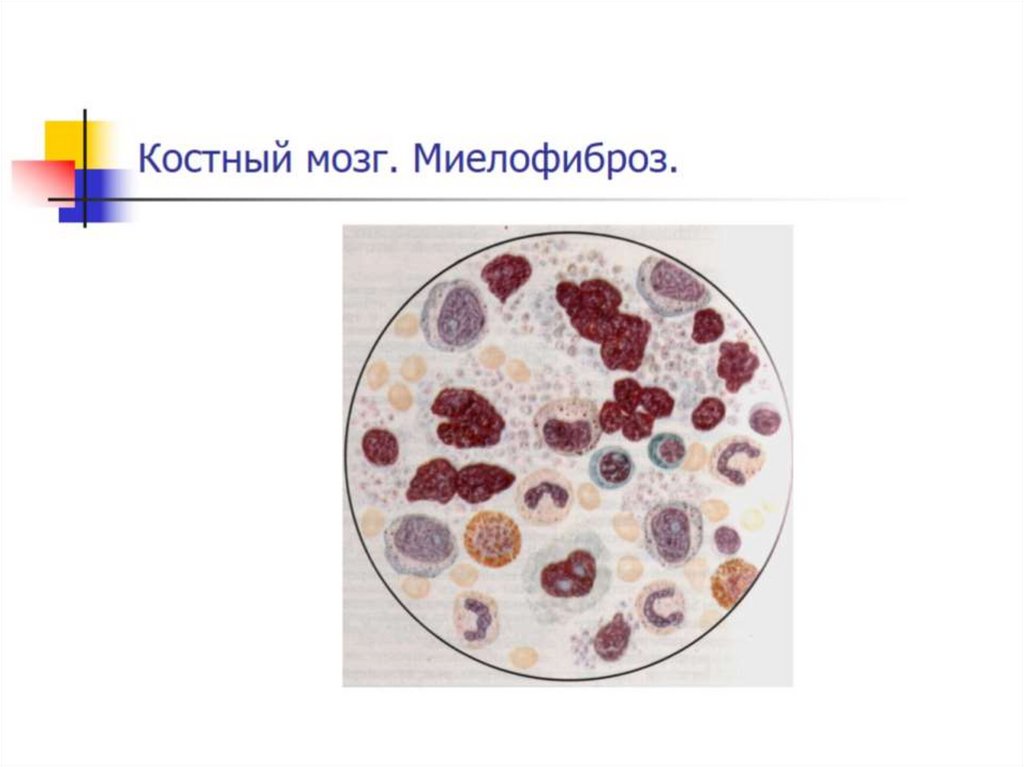 Костный мозг. Миелофиброз.