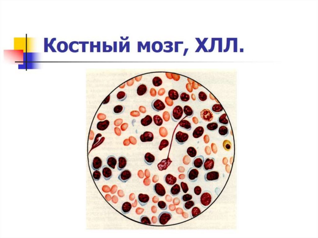 Костный мозг, ХЛЛ.