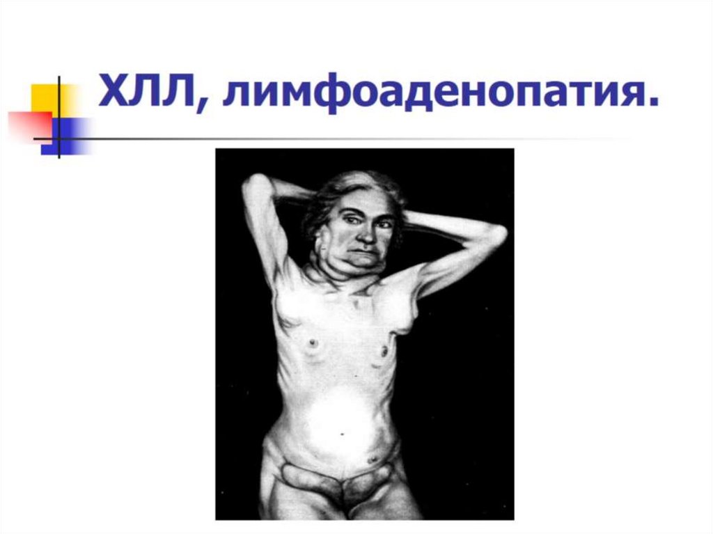 ХЛЛ, лимфоаденопатия.