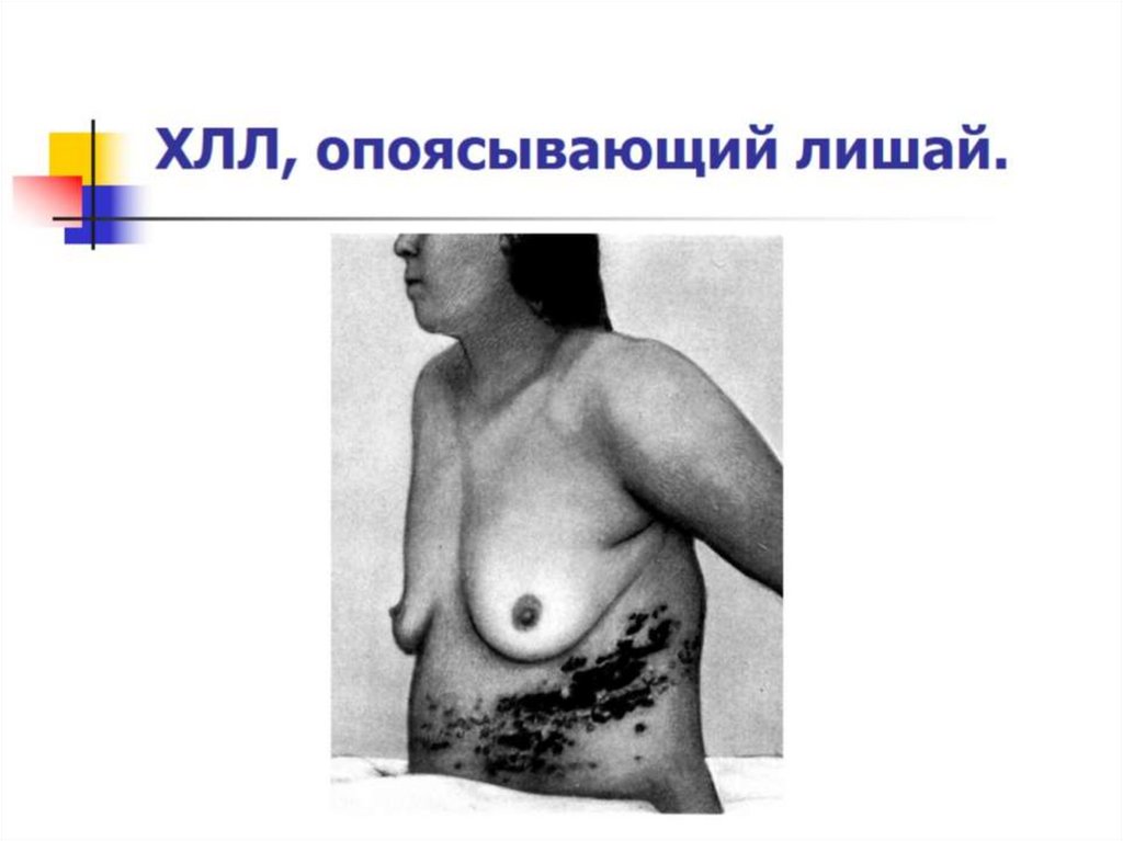 ХЛЛ, опоясывающий лишай.