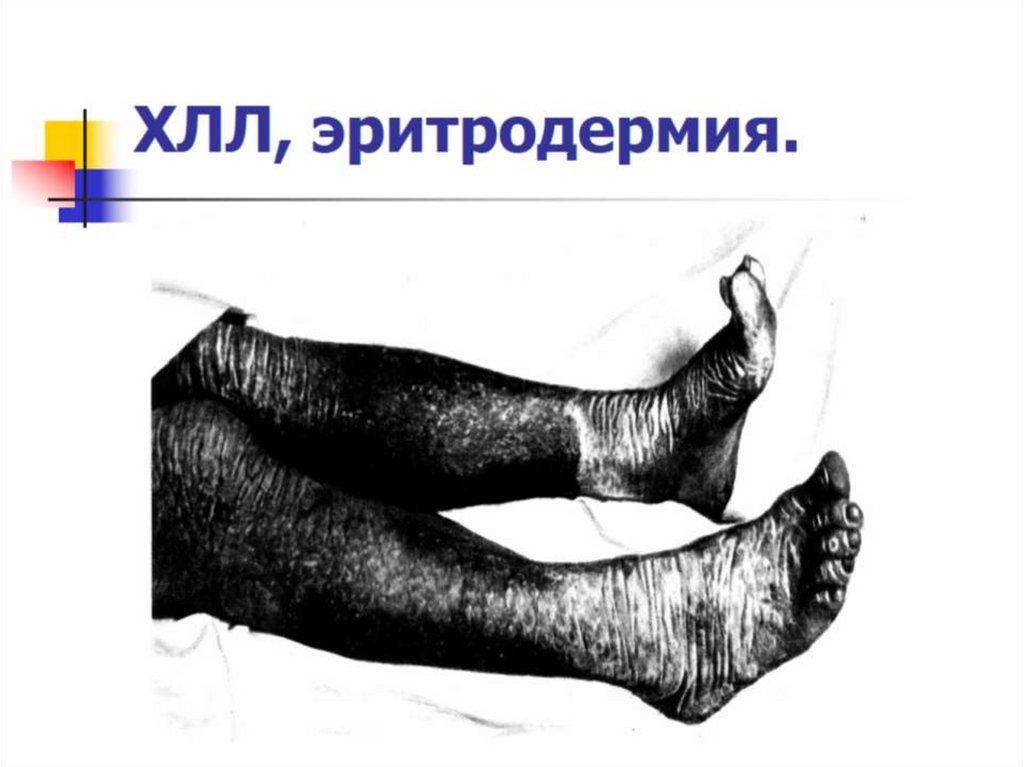 ХЛЛ, эритродермия.