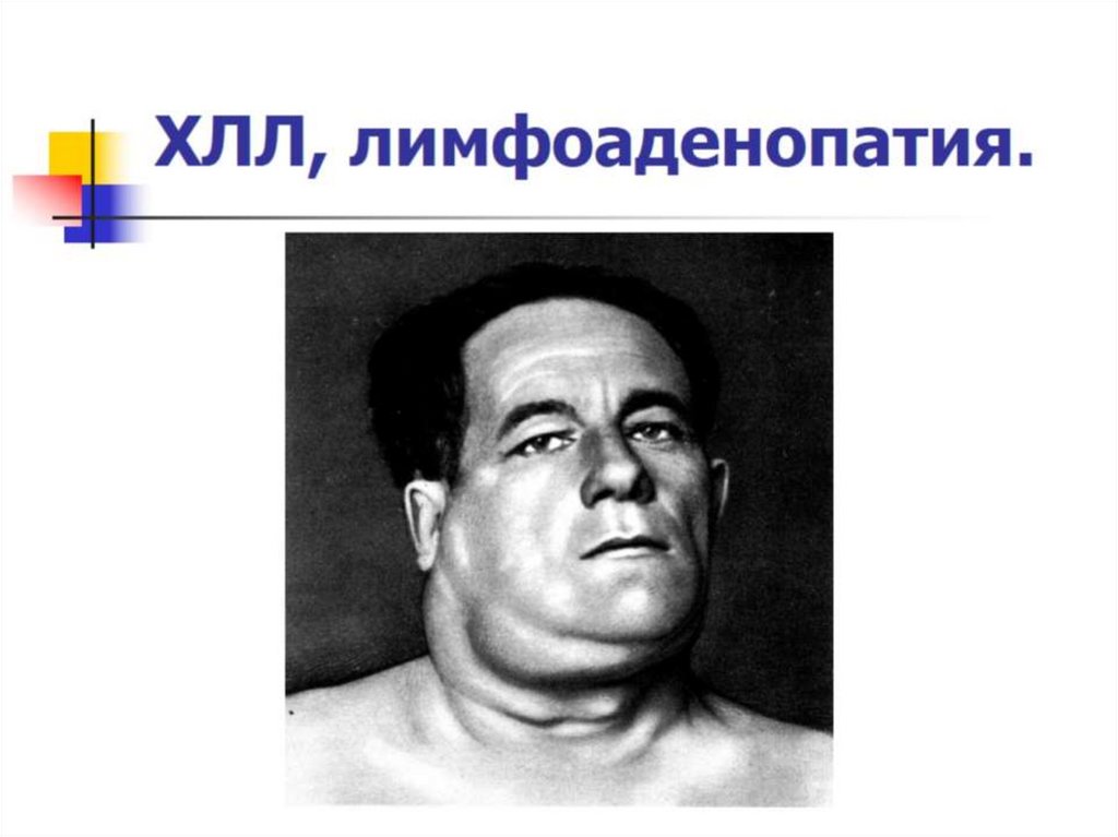 ХЛЛ, лимфоаденопатия.