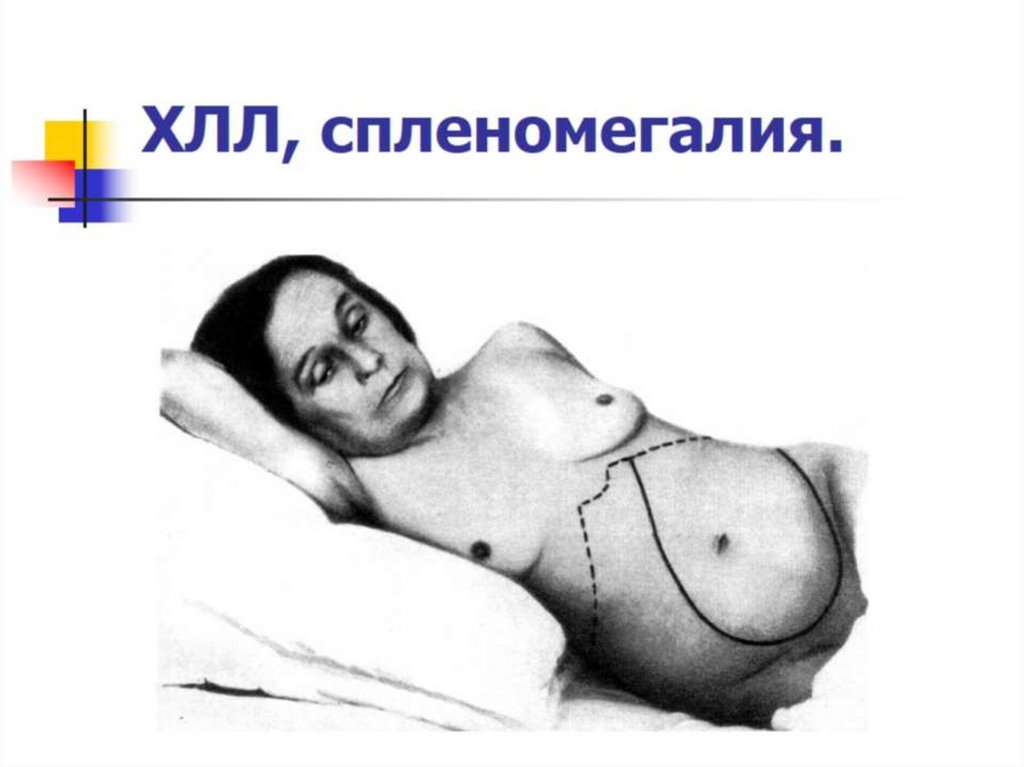 ХЛЛ, спленомегалия.