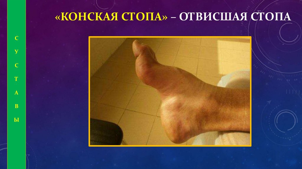 «КОНСКАЯ СТОПА» – ОТВИСШАЯ СТОПА