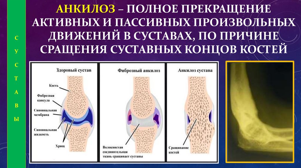 Анкилоз сустава