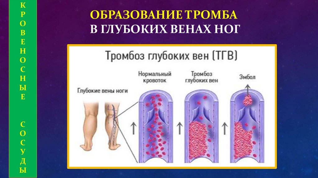 ОБРАЗОВАНИЕ ТРОМБА В ГЛУБОКИХ ВЕНАХ НОГ