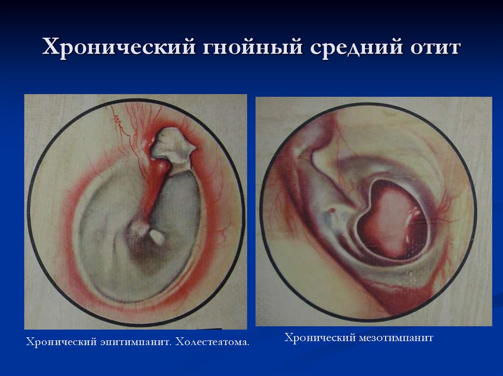 Хронический гнойный средний отит