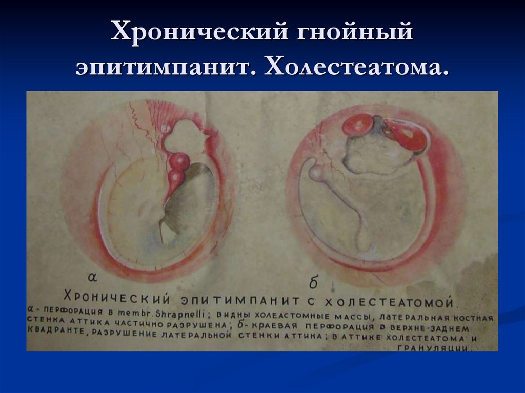 Хронический гнойный средний отит - презентация онлайн