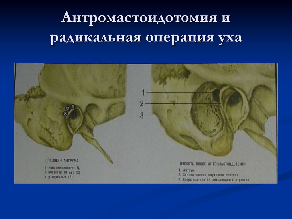 Антромастоидотомия и радикальная операция уха