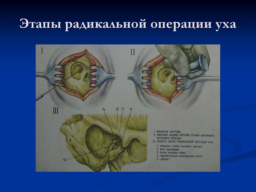 Этапы радикальной операции уха