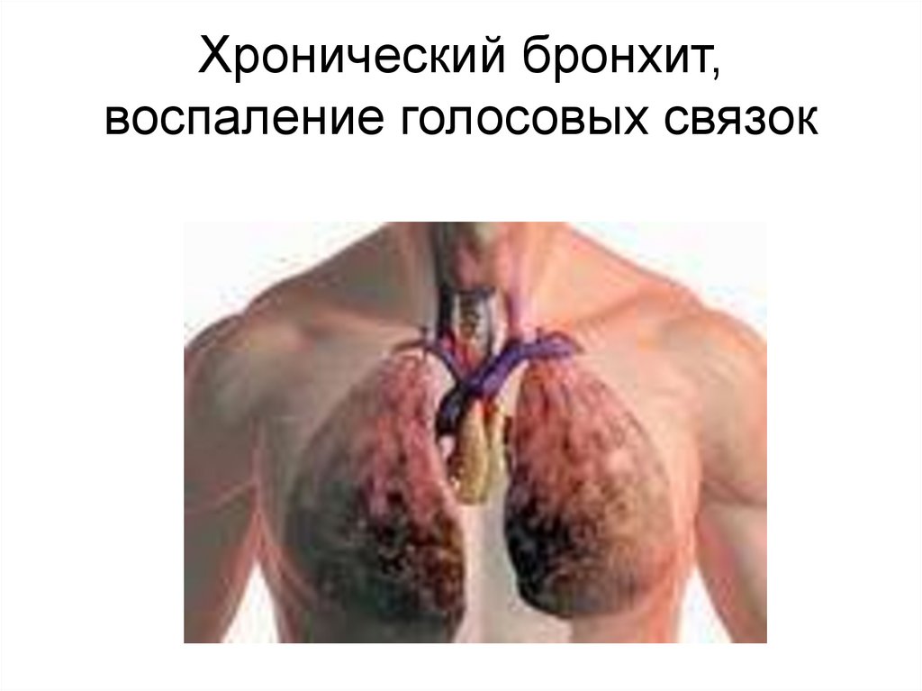 Хронический бронхит, воспаление голосовых связок