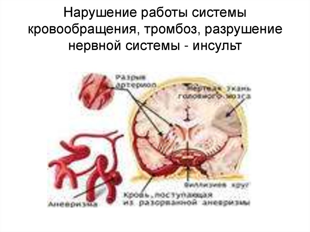 Нарушение работы системы кровообращения, тромбоз, разрушение нервной системы - инсульт