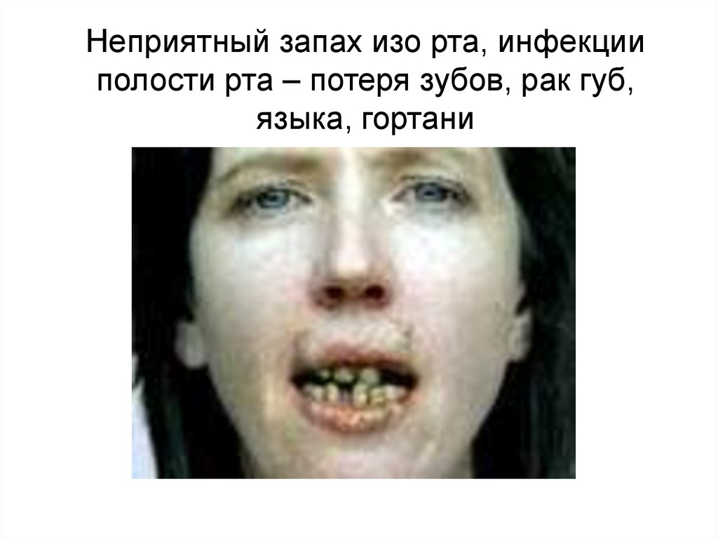 Неприятный запах изо рта, инфекции полости рта – потеря зубов, рак губ, языка, гортани