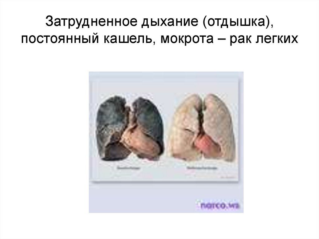 Затрудненное дыхание (отдышка), постоянный кашель, мокрота – рак легких