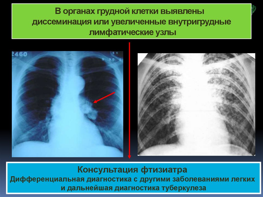 Пульмонология фтизиатрия. Малая форма туберкулеза внутригрудных лимфатических узлов. Туморозная форма туберкулеза внутригрудных лимфатических узлов. Внутригрудные лимфатические узлы увеличены. Туберкулез внутригрудных лимфатических узлов у детей рентген.